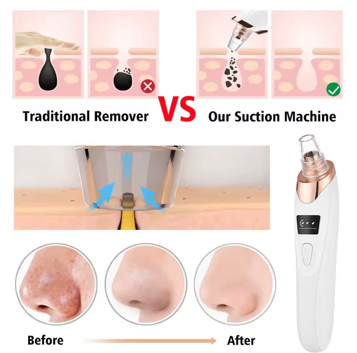Mitesser-Entferner im 3-Saugmodus, Gesichtsreinigung, Schönheitsmaschine, Entferner abgestorbener Haut, Gesichtsvakuum, Mitesserentfernung, Hautpflege-Werkzeug